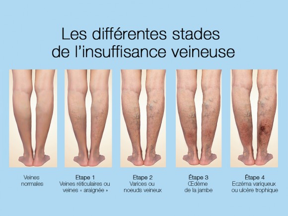 CENTRE Yaoundé Traitement des troubles circulatoires des artères de la jambe