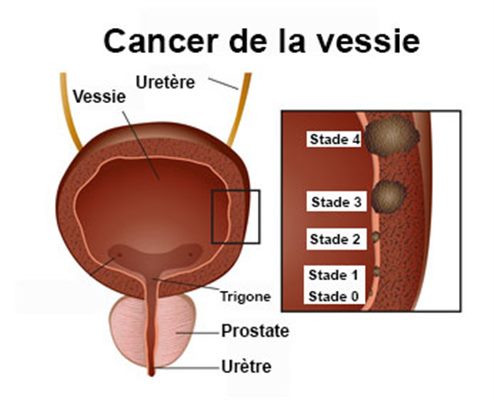 CENTRE Yaoundé Traitement  cancer de la vessie