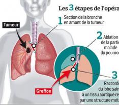 CENTRE Yaoundé Cancers du poumon : les traitements