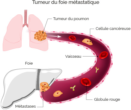 CENTRE Yaoundé Traitement  cancer du foie 