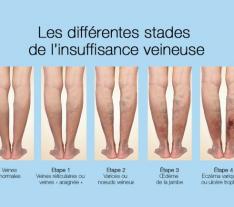 CENTRE Yaoundé Traitement des troubles circulatoires des artères de la jambe